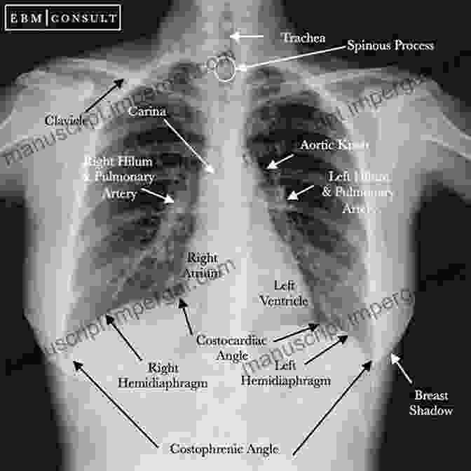 Chest X Ray Showing Airway And Vascular Anatomy Of Thoracic Cavity Chest X Rays For Medical Students: CXRs Made Easy