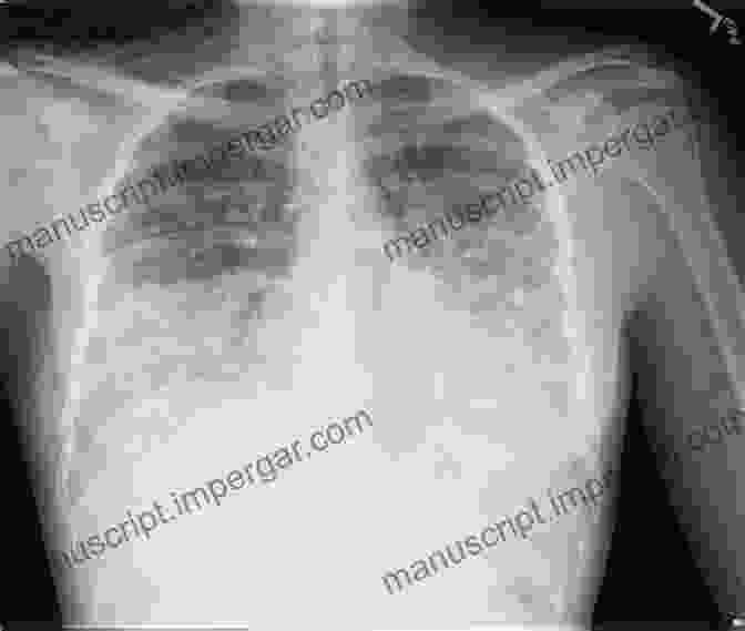 Chest X Ray Showing Infiltrates Associated With Pneumonia Chest X Rays For Medical Students: CXRs Made Easy