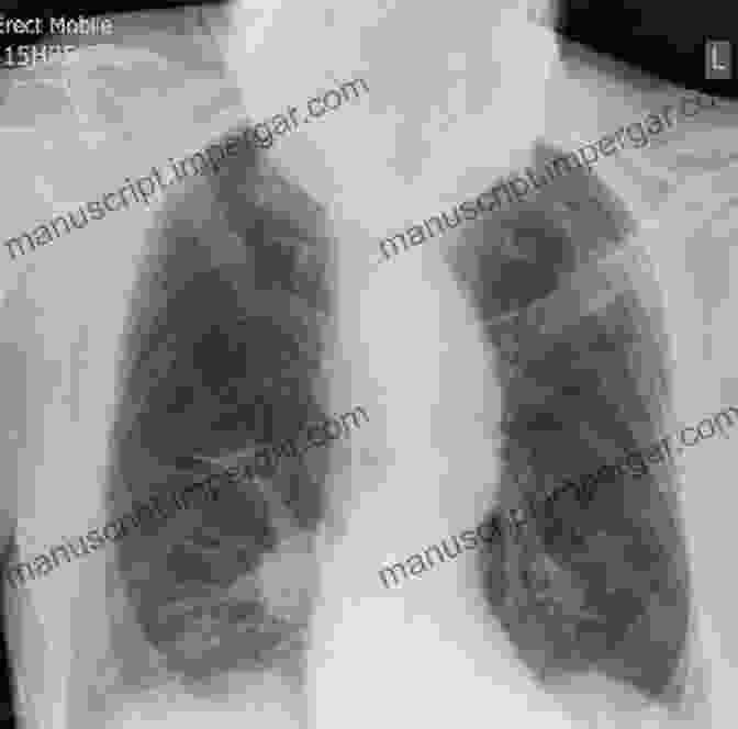 Chest X Ray Showing Pneumothorax With Absent Lung Markings Chest X Rays For Medical Students: CXRs Made Easy