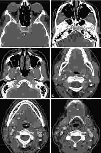 Clinical Radiology Of Head And Neck Tumors